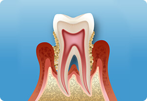 歯周病のイメージ画像